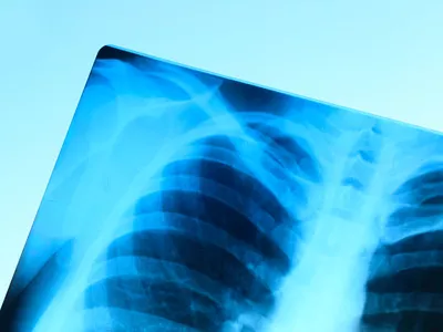 A latens tuberkulózis mint szakmaközi kérdőjel