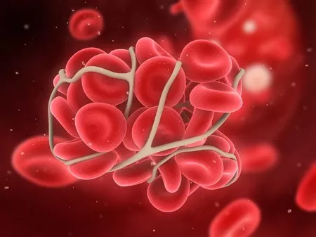 Allergiagyógyszerekkel megelőzhető lehet a mélyvénás trombózis