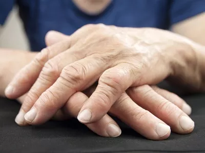 Milyen szakmáknál fokozott a reumatoid arthritis kockázata?