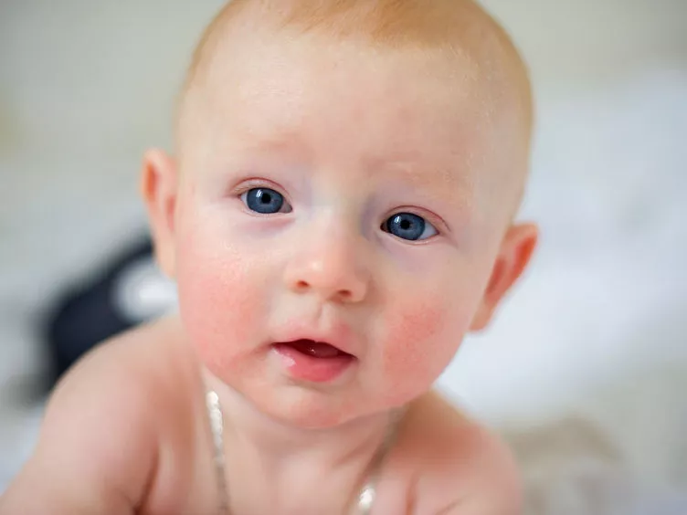 Mikrobiom-spray enyhítheti az atópiás dermatitis tüneteit