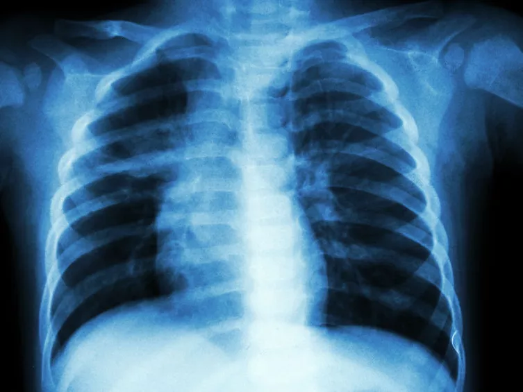 Az F420 kofaktor szintézisének tisztázása segíthet a tuberculosis gyógyításában