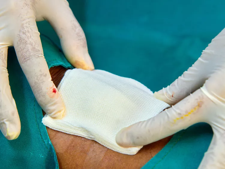 Vérzéscsillapító, sebbe nem tapadó kötszerbevonat