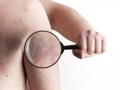 Ekcémák: diagnosztizálás és kezelés