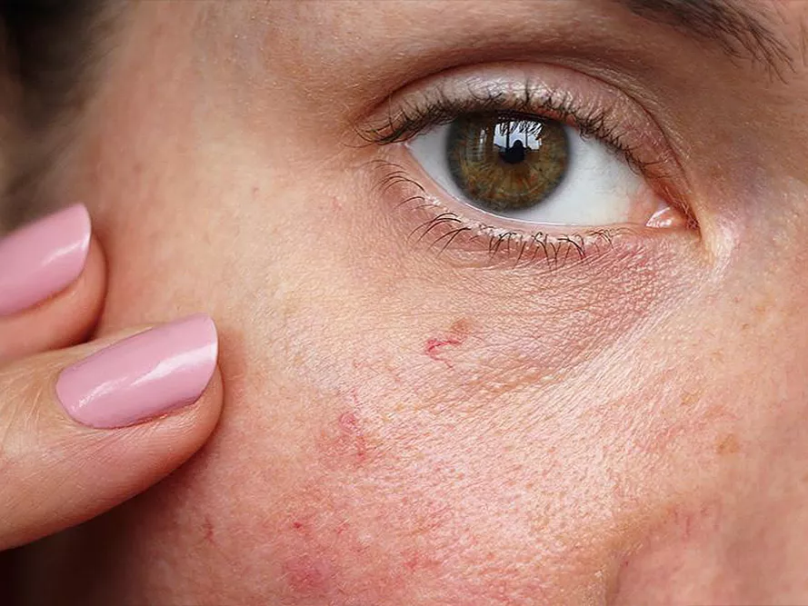 Rosacea? Legyen óvatos a napozással!