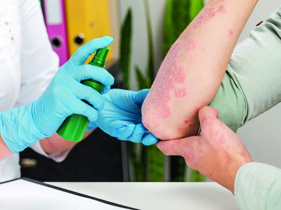 Atópiás dermatitis és pszoriázis: segíthetnek az antioxidánsok?